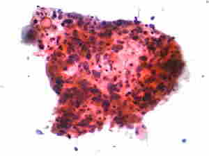 Grappolo di cellule squamose di carcinoma polmonare in cui si evidenzia la variazione nelle dimensioni e colorazione dei nuclei, i nucleoli piccoli e indistinti, lo scarso citoplasma, la cheratinizzazione