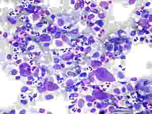 Cellula di Reed-Sternberg (cellula popcorn) circondata da leucociti